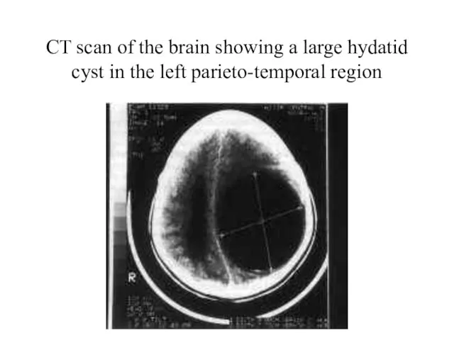 CT scan of the brain showing a large hydatid cyst in the left parieto-temporal region