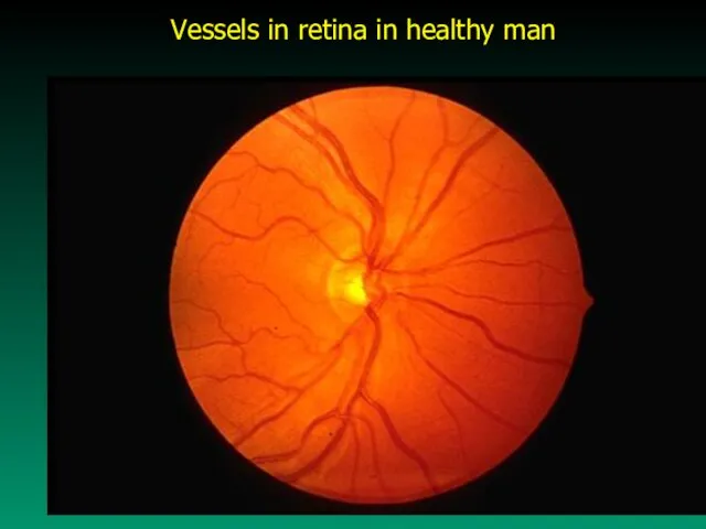 Vessels in retina in healthy man