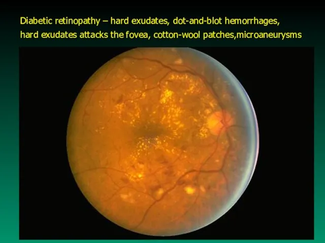 Diabetic retinopathy – hard exudates, dot-and-blot hemorrhages, hard exudates attacks the fovea, cotton-wool patches,microaneurysms