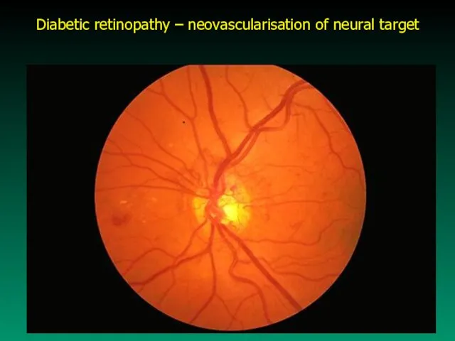 Diabetic retinopathy – neovascularisation of neural target