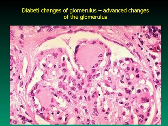 Diabeti changes of glomerulus – advanced changes of the glomerulus