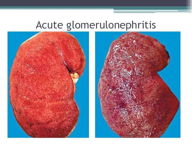 Acute glomerulonephritis
