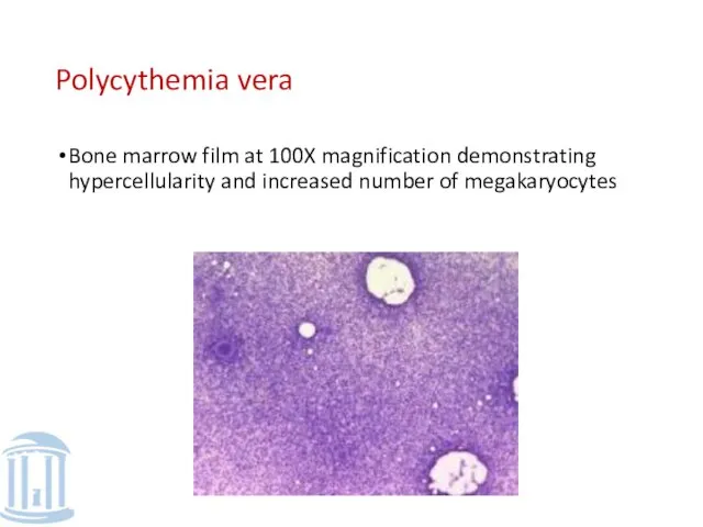 Polycythemia vera Bone marrow film at 100X magnification demonstrating hypercellularity and increased number of megakaryocytes