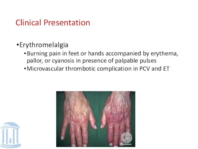 Clinical Presentation Erythromelalgia Burning pain in feet or hands accompanied by erythema, pallor,