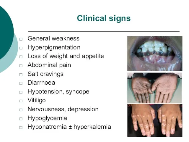 Clinical signs General weakness Hyperpigmentation Loss of weight and appetite