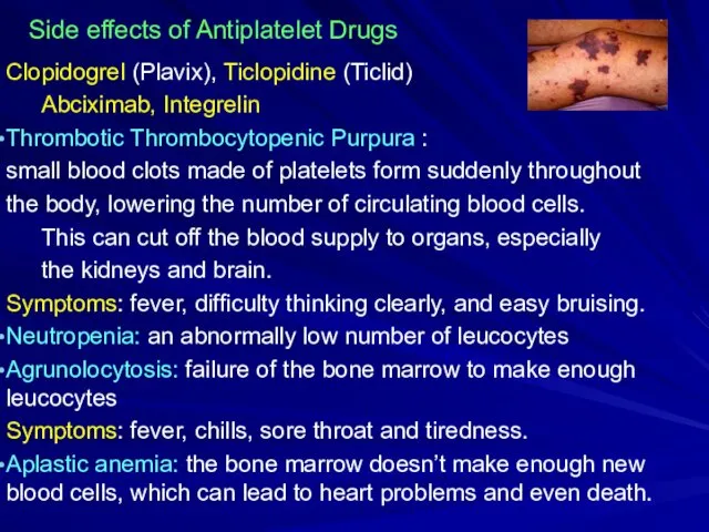 Side effects of Antiplatelet Drugs Clopidogrel (Plavix), Ticlopidine (Ticlid) Abciximab,