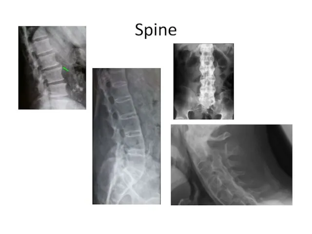 Spine