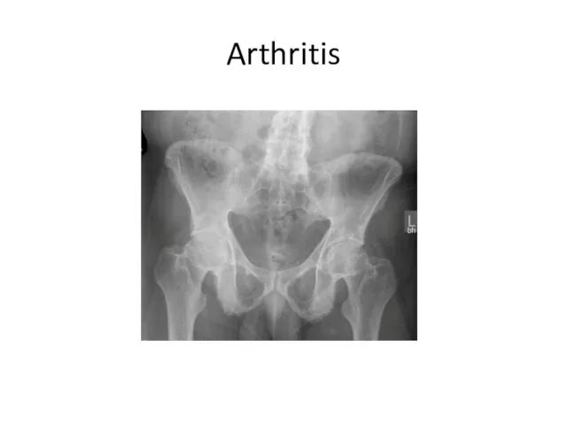 Arthritis