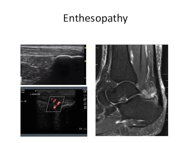 Enthesopathy