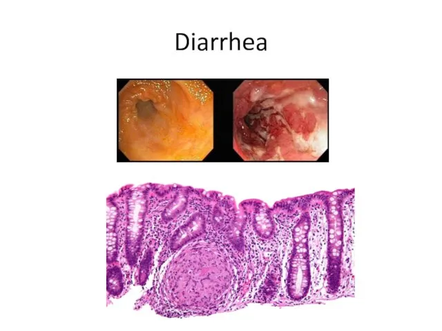 Diarrhea