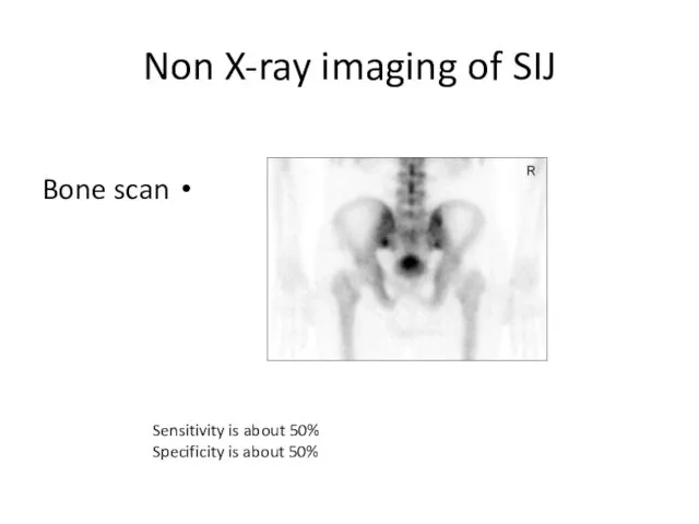 Non X-ray imaging of SIJ Bone scan Sensitivity is about 50% Specificity is about 50%