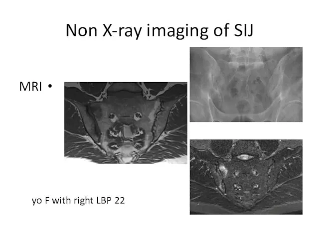 Non X-ray imaging of SIJ MRI 22 yo F with right LBP