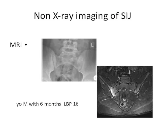 Non X-ray imaging of SIJ MRI 16 yo M with 6 months LBP