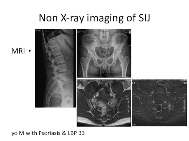 Non X-ray imaging of SIJ MRI 33 yo M with Psoriasis & LBP