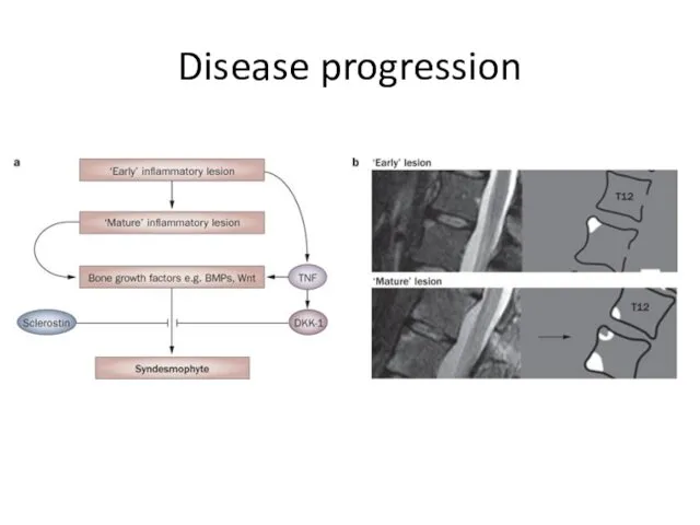 Disease progression