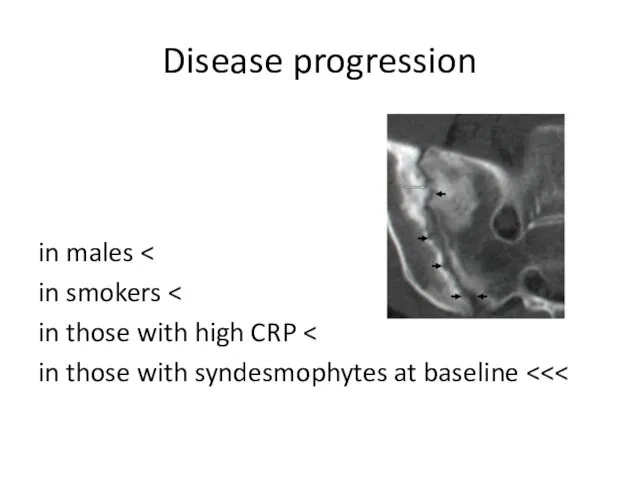 Disease progression > in males > in smokers > in