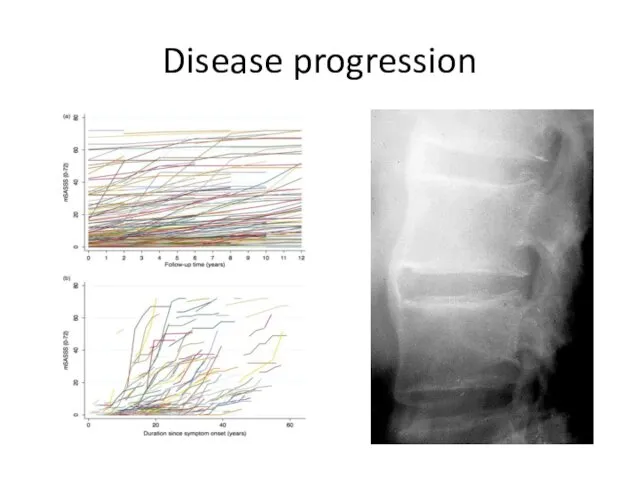 Disease progression