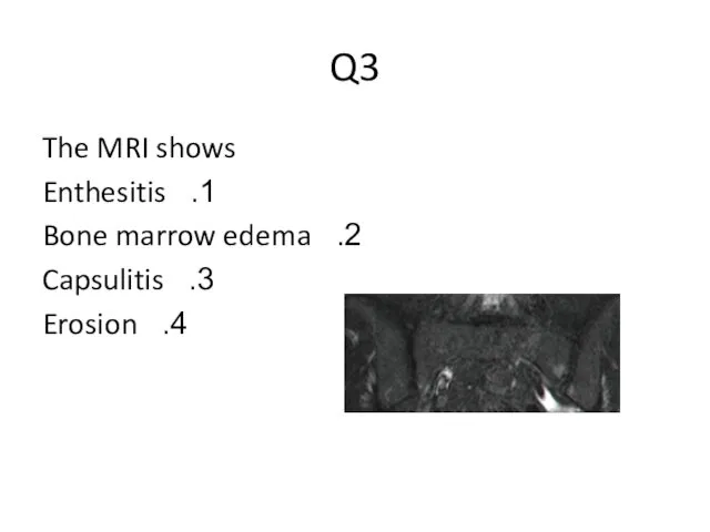 Q3 The MRI shows Enthesitis Bone marrow edema Capsulitis Erosion