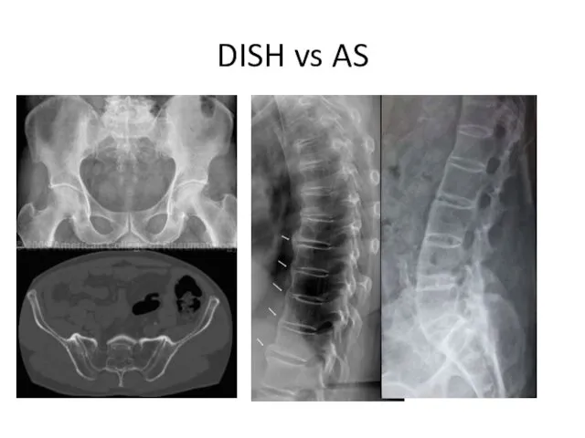 DISH vs AS