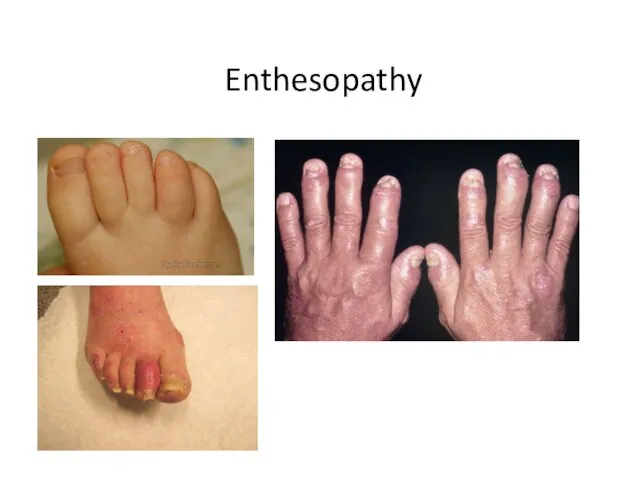 Enthesopathy