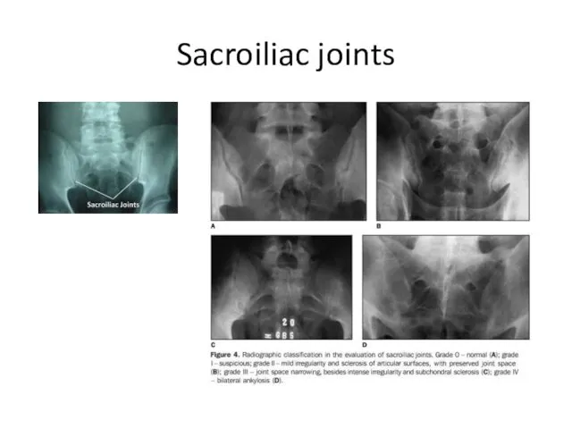 Sacroiliac joints
