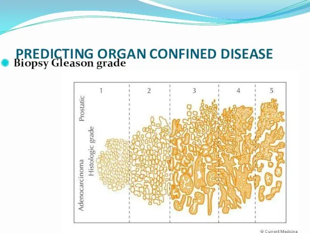 Dr.Neiman Victoria PREDICTING ORGAN CONFINED DISEASE Biopsy Gleason grade