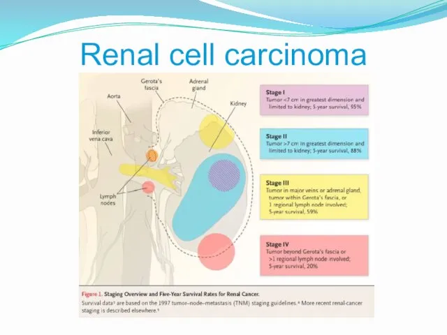 Renal cell carcinoma