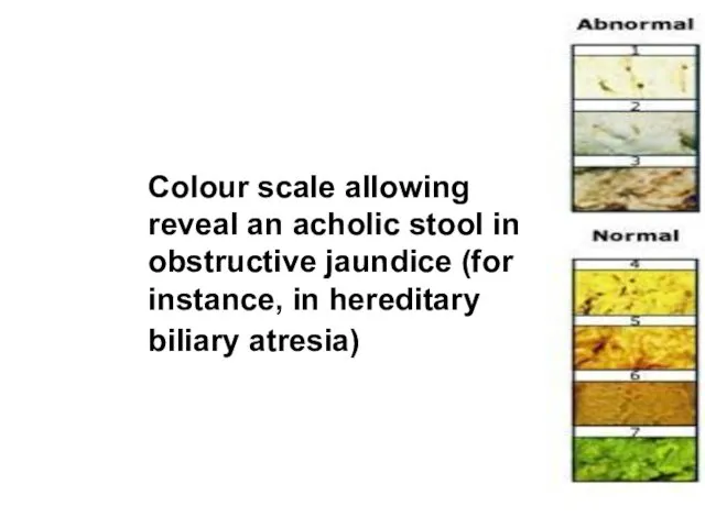 Colour scale allowing reveal an acholic stool in obstructive jaundice (for instance, in hereditary biliary atresia)