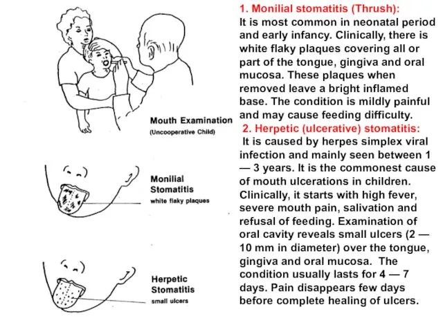 1. Monilial stomatitis (Thrush): It is most common in neonatal