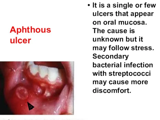 It is a single or few ulcers that appear on