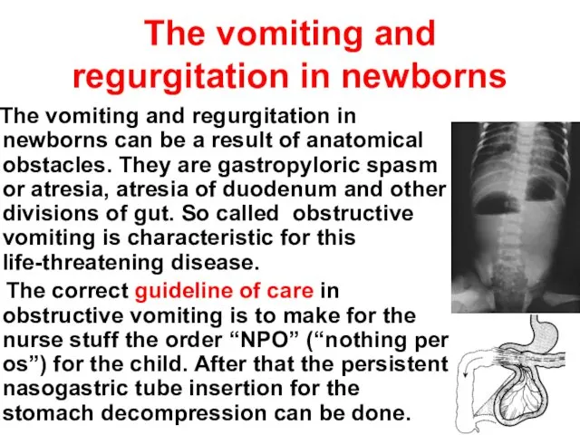 The vomiting and regurgitation in newborns The vomiting and regurgitation