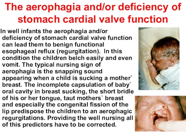 The aerophagia and/or deficiency of stomach cardial valve function In