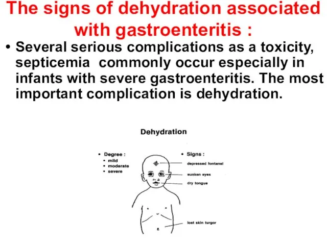 The signs of dehydration associated with gastroenteritis : Several serious