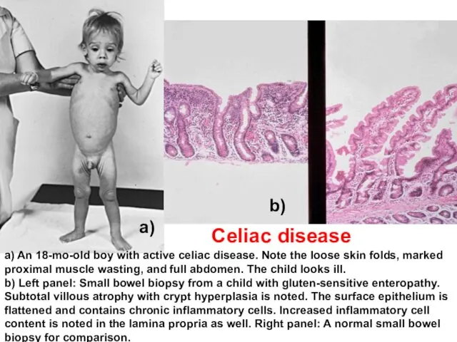 a) An 18-mo-old boy with active celiac disease. Note the