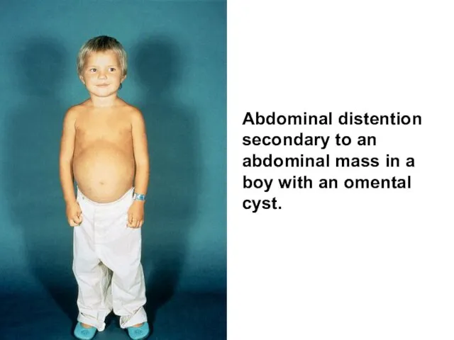 Abdominal distention secondary to an abdominal mass in a boy with an omental cyst.