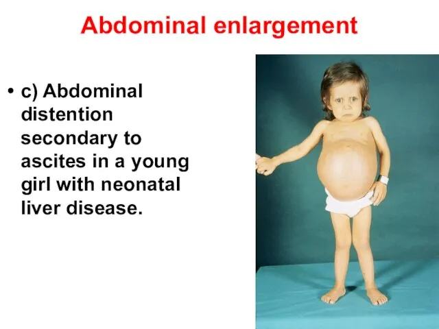 Abdominal enlargement c) Abdominal distention secondary to ascites in a young girl with neonatal liver disease.