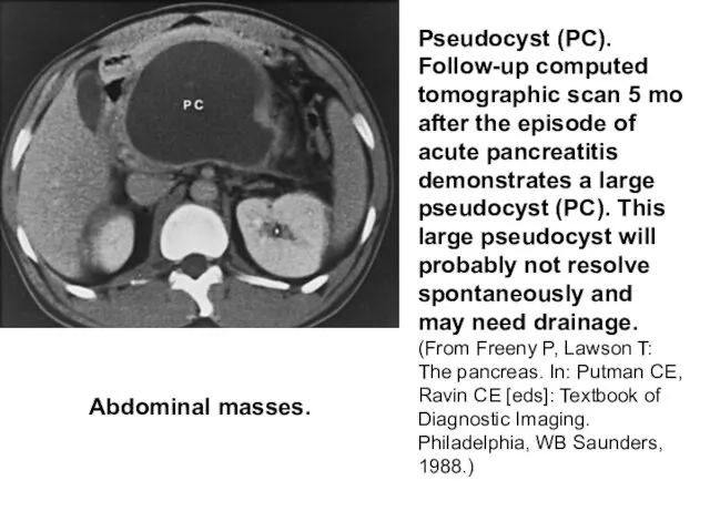 Pseudocyst (PC). Follow-up computed tomographic scan 5 mo after the