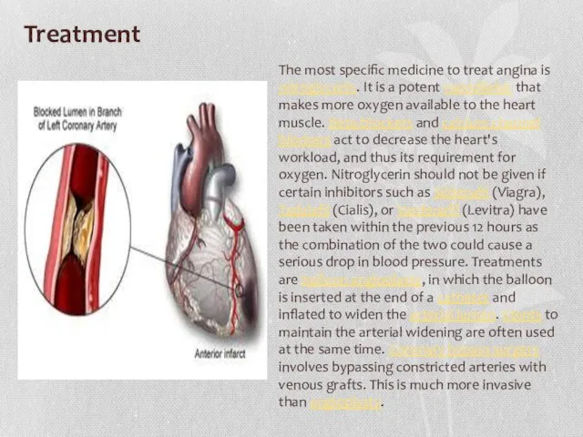 Treatment The most specific medicine to treat angina is nitroglycerin.