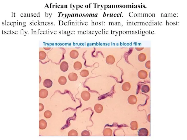 African type of Trypanosomiasis. It caused by Trypanosoma brucei. Common
