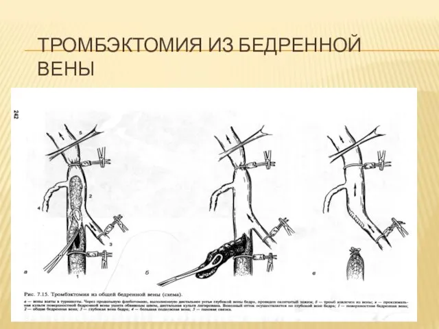 ТРОМБЭКТОМИЯ ИЗ БЕДРЕННОЙ ВЕНЫ