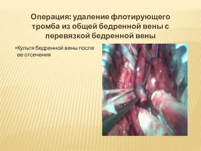 Операция: удаление флотирующего тромба из общей бедренной вены с перевязкой