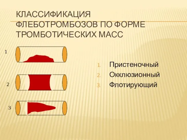 КЛАССИФИКАЦИЯ ФЛЕБОТРОМБОЗОВ ПО ФОРМЕ ТРОМБОТИЧЕСКИХ МАСС Пристеночный Окклюзионный Флотирующий 1 2 3