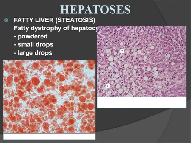 FATTY LIVER (STEATOSIS) Fatty dystrophy of hepatocytes - powdered - small drops - large drops HEPATOSES