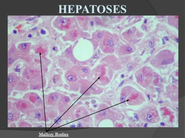 HEPATOSES Mallory Bodies