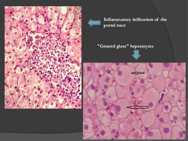 Inflammatory infiltration of the portal tract "Ground glass" hepatocytes