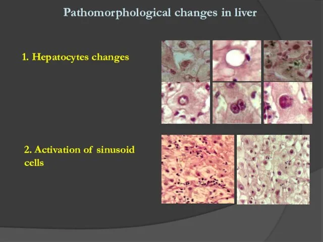 Pathomorphological changes in liver 1. Hepatocytes changes 2. Activation of sinusoid cells