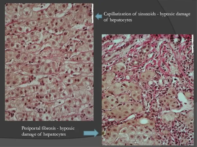 Capillarization of sinusoids - hypoxic damage of hepatocytes Periportal fibrosis - hypoxic damage of hepatocytes