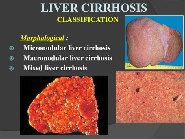 CLASSIFICATION Morphological : Micronodular liver cirrhosis Macronodular liver cirrhosis Mixed liver cirrhosis LIVER CIRRHOSIS