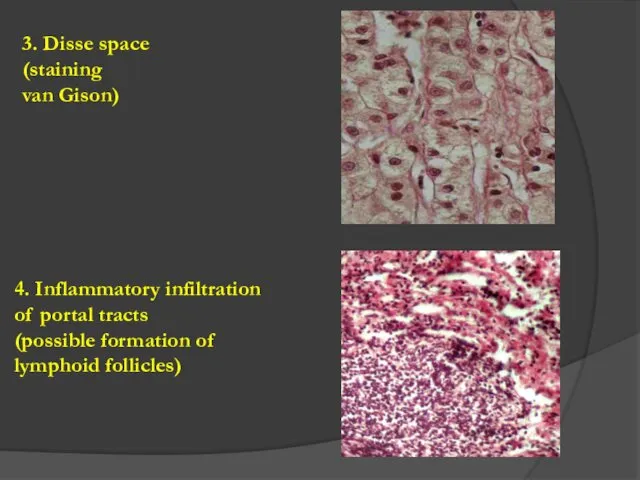 3. Disse space (staining van Gison) 4. Inflammatory infiltration of