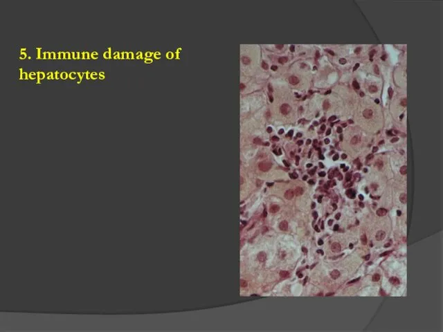 5. Immune damage of hepatocytes